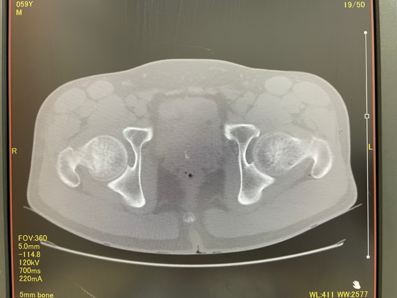 骨折時股関節CT水平断