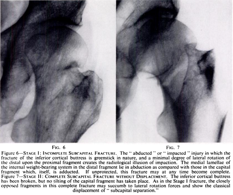 Garden RS. J Bone Joint Surg. 1961. 43-B. Fig 6. Fig. 7.