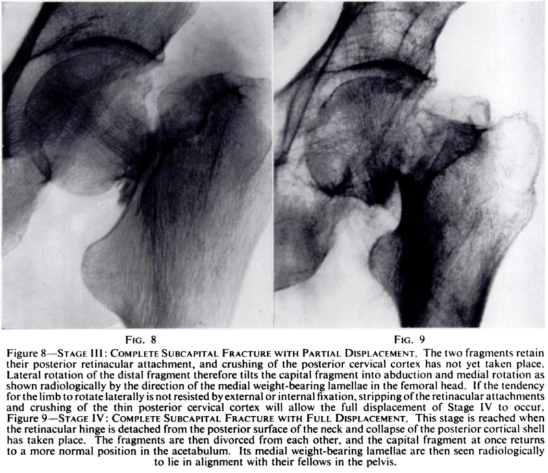 Garden RS. J Bone Joint Surg. 1961. 43-B. Fig. 8. Fig. 9.