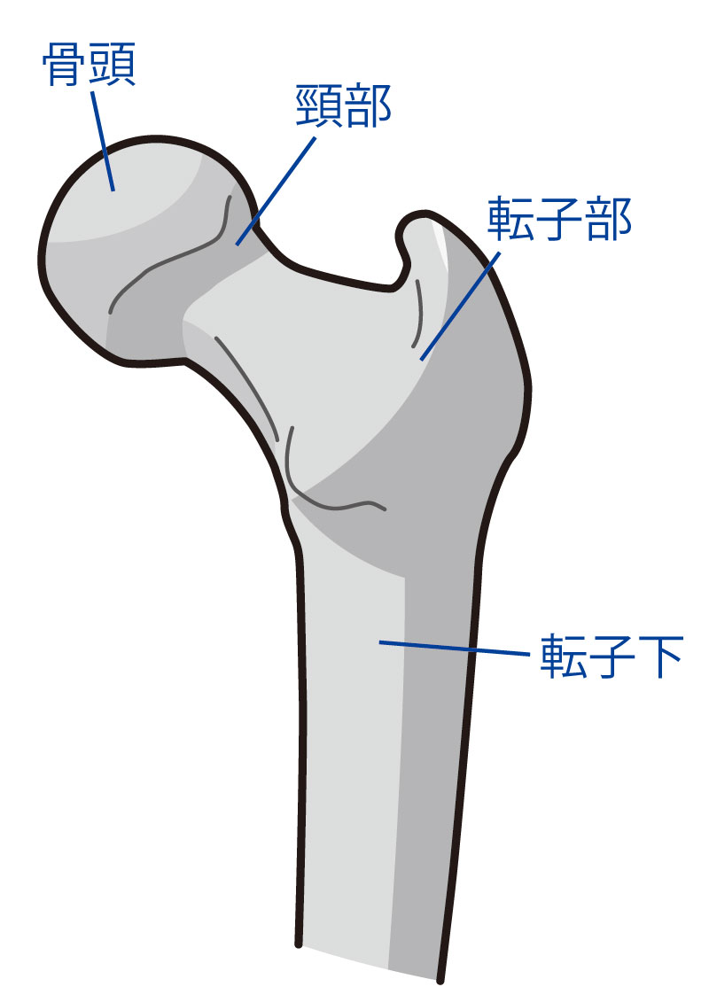 大腿骨近位部の各部名称