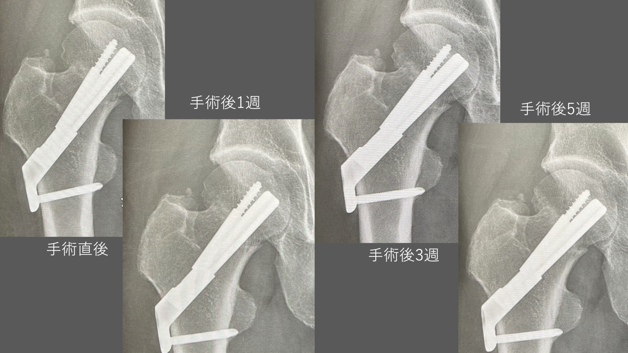 大腿骨頚部骨折後の経過術後5週