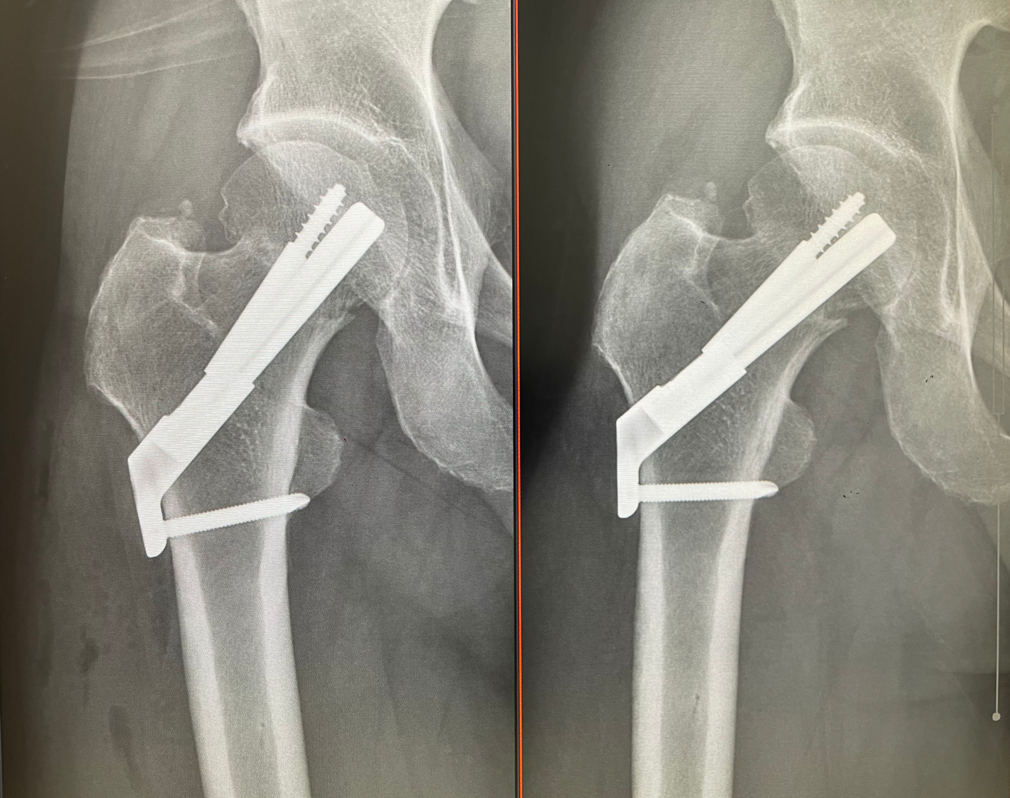 大腿骨頚部骨折手術直後と手術後9週間経過のX線写真