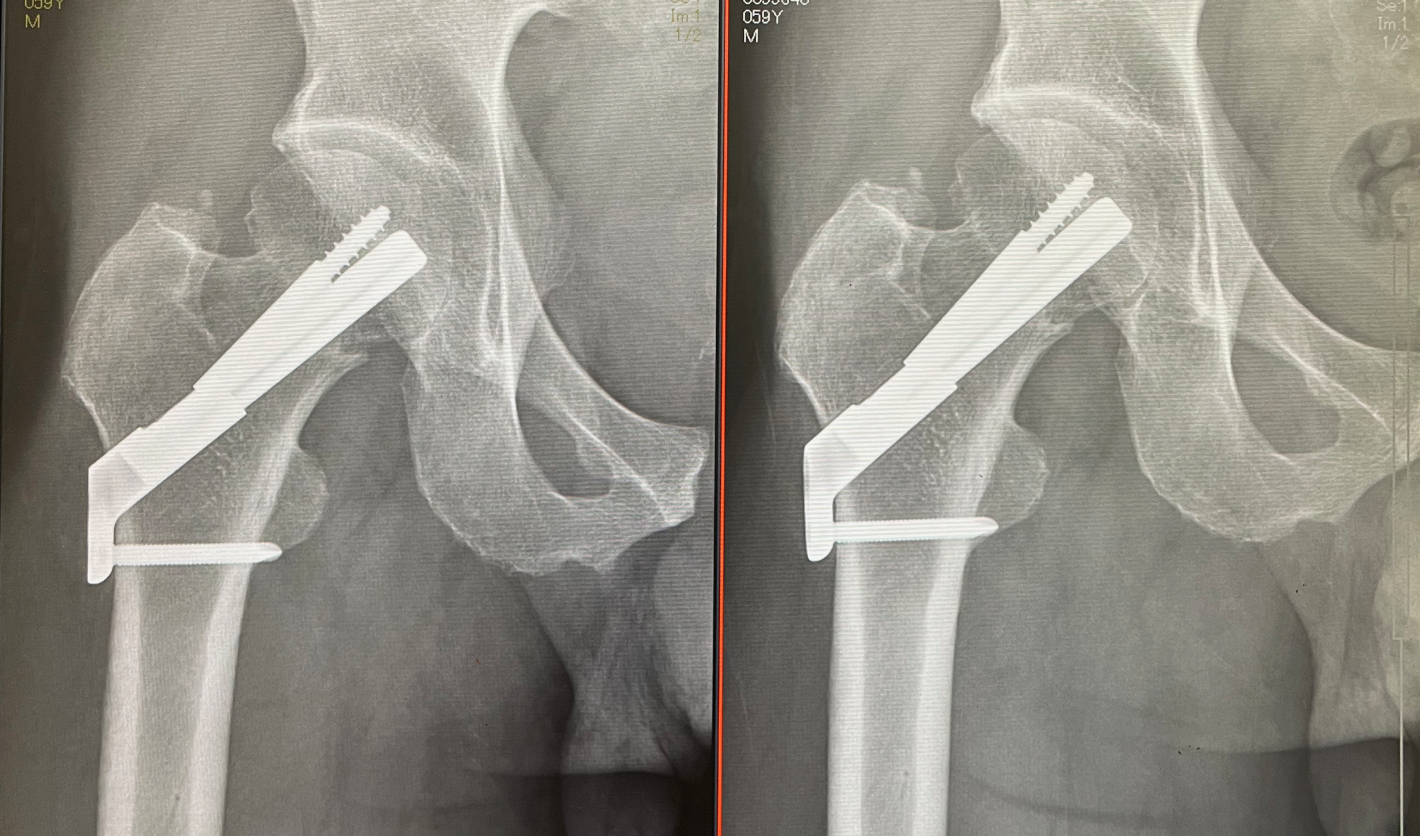 大腿骨頚部骨折手術後2ヶ月後と3ヶ月後のX瀬線写真