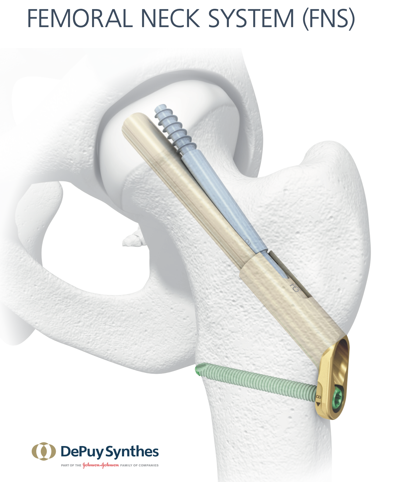 Depy Synshes社のFemoral Neck System