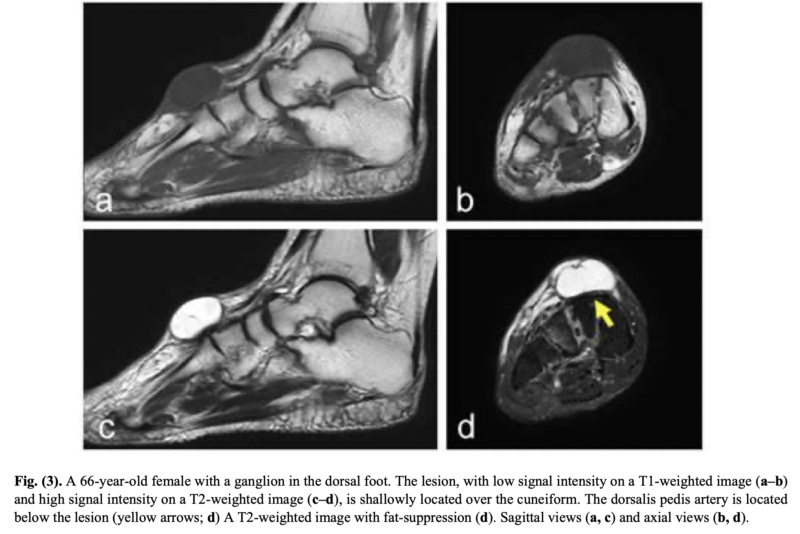 足の甲のガングリオンのMRI