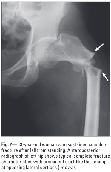 非定型大腿骨転子下骨折のX線写真